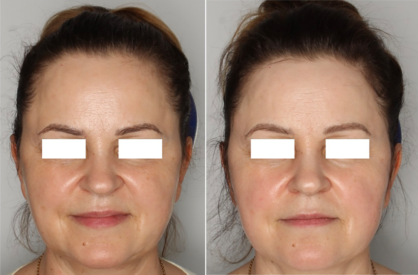 Kwas ferulowy + witamina C – Serum antyoksydacyjne